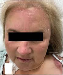 Erythematous desquamating rash after initiation of chemotherapy