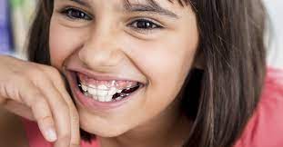 Retainer Types Bonded Hawley Essix And Clear Retainers Dental Retainer Retainers Clear Retainers