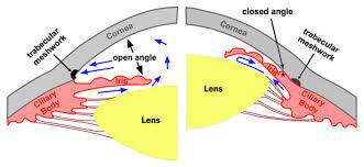 Glaucoma is one of the leading causes of preventable blindness. Closed Angle Gglaucoma Explanation Melbourne Eye Centre