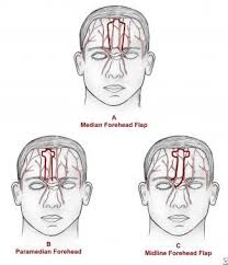 A Is A Median Forehead Flap Over The Forehead Vasc Reconstructive Surgery Forehead Oral Surgery