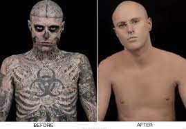 At dermablend micropigmenation clinic, we specialize in camouflaging various birthmarks, scars & surgical scars, burns, hypopigmentation, and in 3d areola restoration. Dermablend Tattoo Cover Up Tattoo Gallery Collection