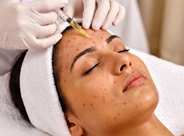The Treatment To Try This Halloween: The Vampire Facial