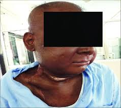 Sep 30, 2019 · torticollis (wry neck, or loxia) is one of a broader category of disorders that exhibit flexion, extension, or twisting of muscles of the neck beyond their normal position. Torticolis As A Delayed Sequence Of Radiation Therapy In A H And N Download Scientific Diagram