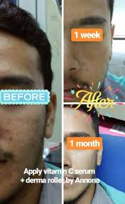 Lazimnya, kesan ke atas kulit dapat dilihat tiga hingga empat hari selepas suntikan. Bff S Skincare Set Vitamin C Series Annona Azani Beauty Health