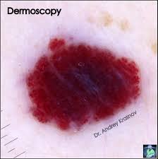 Красные родинки: причины появления красных точек на теле и грудях — MLC