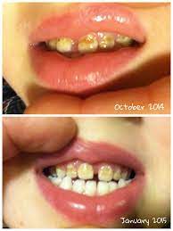 Heal Your Teeth Naturally Heal Cavities Baby Tooth Decay Cure Tooth Decay