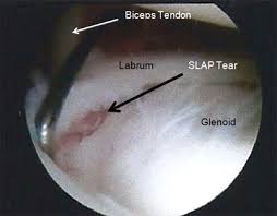 Image result for SLAP Lesion