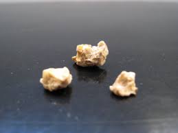 Kidney Stone Fragments Medullary Sponge Kidney Treat Kidney Stones Kidney Stones