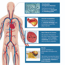 Inflammation is part of the body's natural response to protect itself against harm. Obesity Heart Disease Gum Disease Boh Dental
