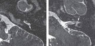 Image result for Bacterial Labyrinthitis