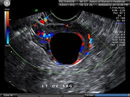 Image result for First Trimester Ultrasound
