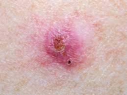 Try our symptom checker got any other symptoms? Basal Cell Cancer Signs Symptoms And Complications