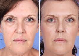 We did not find results for: Micro Needling Before After Photos Dr Sikorski Natural Image Oc