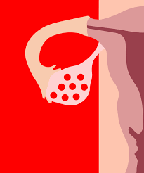 Eisprung, follikelsprung oder ovulation bezeichnet den vorgang im menstruationszyklus, bei dem eine unbefruchtete eizelle aus einem reifen follikel ausgestoßen wird und in den eileiter wandert, wo sie von einem spermium befruchtet werden kann. Diese Zeichen Deuten Auf Einen Eisprung Hin