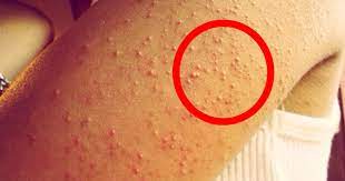 How To Get Rid Of Chicken Skin Aka Keratosis Pilaris Keratosis Pilaris Skin Cleanser Products Chicken Skin