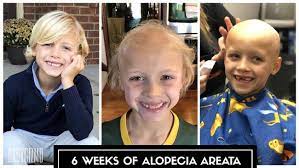 The hoodie style is one of the most popular long hair cuts for boys, where the straight and long bangs fall from the back of the head to form a hoodie. Why My Son Is Bald 6 Weeks With Alopecia Areata Baby Gizmo