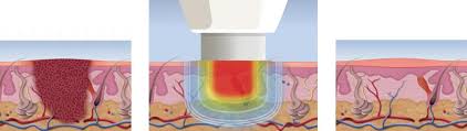 Check spelling or type a new query. Plantar Wart Treatment With Lasers For Wart Removal Bvfc
