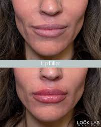 Our signature lip filler blends expertise and artistry to create lips that  perfectly complement you ✨ 🗓️ Love your look—Book your appointment today  at LookLab.com or call 833.999.5665 (LOOK) #LipFiller #Filler #MedSpa