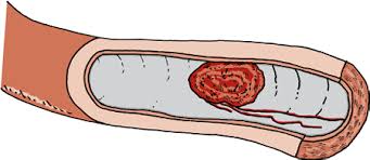 Chronic coughing seems to be the most common abnormality that is seen in dogs with lung cancer. Blood Clots And Aneurysms In Dogs Dog Owners Merck Veterinary Manual