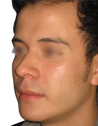 Bichectomía en Bogotá