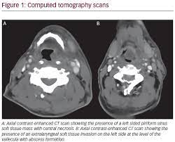 Thus, throat cancer refers to those cancerous tumours which grow within the throat of an individual. Invasive Epiglottic Aspergillosis Mimicking Supraglottic Laryngeal Carcinoma A Case Report And Review Of The Literature Touchoncology