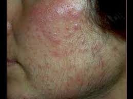 Both, acne and ingrown hair develop in hair follicles. Dermtv Acne And Facial Hair Dermtv Com Epi 334 Youtube