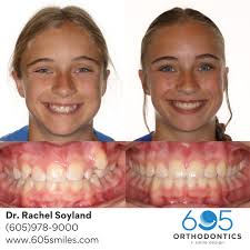 ⚡ Smile Alert ⚡ This patient came to our office with a few concerns: 🦷  Crowding 🦷 Upper midline off-center Dr. Rachel created a treatment plan  that consisted of braces and elastics.