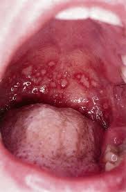 Image result for Strep throat infection roof of mouth