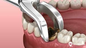 Excessive average dental cost means you are getting unnecessary dental work ( dentist scam) by greedy business dentists. Tooth Extraction Costs With Without Insurance Newmouth