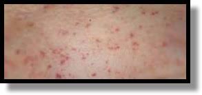 Sepsis has other signs and symptoms that you should not ignore. Meningococcemia And Petechiae Pediatric Em Morsels