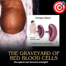 Image result for Splenomegaly