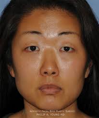 Maybe you would like to learn more about one of these? Asian Double Eyelid Crease Procedure Seattle Bellevue