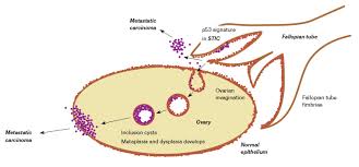 Recently, however, researchers have found that women actually do often have symptoms, such as abdominal bloating, feeling full rapidly when eating, pelvic. Racgp Advances In Epithelial Ovarian Cancer