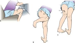 The pcl is one of the major ligaments found in the human knee. Hip And Femur Injuries Anesthesia Key