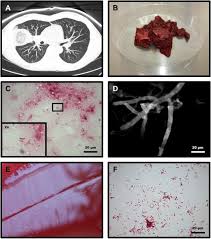 Maybe you would like to learn more about one of these? Pulmonary Campylobacter Concisus Infection In An Immunocompromised Patient With Underlying Mucormycosis International Journal Of Infectious Diseases