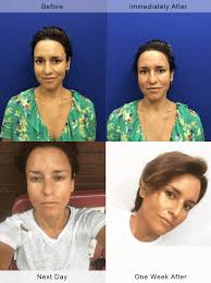 We did not find results for: Microneedling Skin Rejuvination In Nyc Neinstein Plastic Surgery