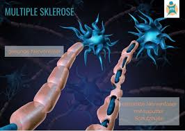 Die multiple sklerose (encephalomyelitis disseminata) ist eine was ist multiple sklerose? Multiple Sklerose Ihre Apotheke Informiert Uber Krankheiten