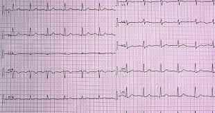 All acute coronary syndromes that do not for the sake of clarity: Morphine And Cardiovascular Outcomes Among Patients With Non St Segment Elevation Acute Coronary Syndromes Undergoing Coronary Angiography