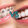 However, the national average price for invisalign is between $3,000 and $5,000. 1