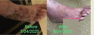 Image result for Lichen Simplex Chronicus