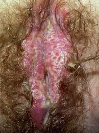 Ingrown Hair vs. Herpes: Symptoms, Causes, Treatment