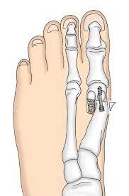Hallux valgus ist der medizinische fachausdruck für eine deformierte grosszehe. Hallux Valgus Operation Klinik Impuls