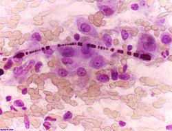 mesothelioma comprehensive review covers malignant mesothelioma, such as peritoneal and pleural varieties of this most cancers. Asbestose Wikipedia