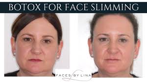 Often multiple syringes are needed to achieve the desired look. How To Have A Slim Face Can Botox Help Glen Dental