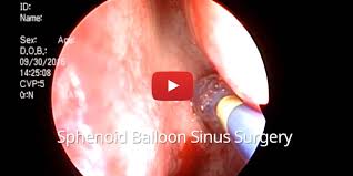 Image result for Sinus Surgery