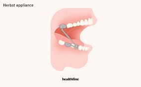 Dental braces are orthodontic devices that help align and straighten teeth, as well as fix gaps. Can I Straighten Teeth Without Braces All About The Options