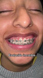 Evolución de @jlynsky23 en #Dentalpro @karlaortodoncista  🤩🫶🏻#ortodoncistaentiktok #dentistaentiktok #brackets #fyp #progreso
