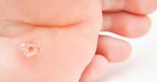 2 Adet Aspirini Eritin Ve Bitkilog Aspirin Herbs Remedies