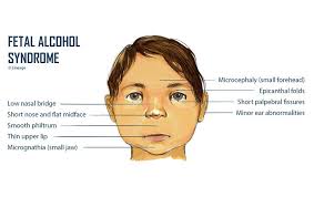 An abnormally long vertical groove in the center of the upper lip (philtrum); Meditech Sa On Twitter September 9th Is International Foetal Alcohol Syndrome Day Awareness Drinking Alcohol While Pregnant Can Cause Permanent Damage To Your Unborn Baby Fasd Noamountofalcoholissafe Stayawayfromalcohol Https T Co Znohas2ilq