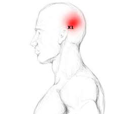 Temporalis Schmerzen Triggerpunkte Selbst Behandeln